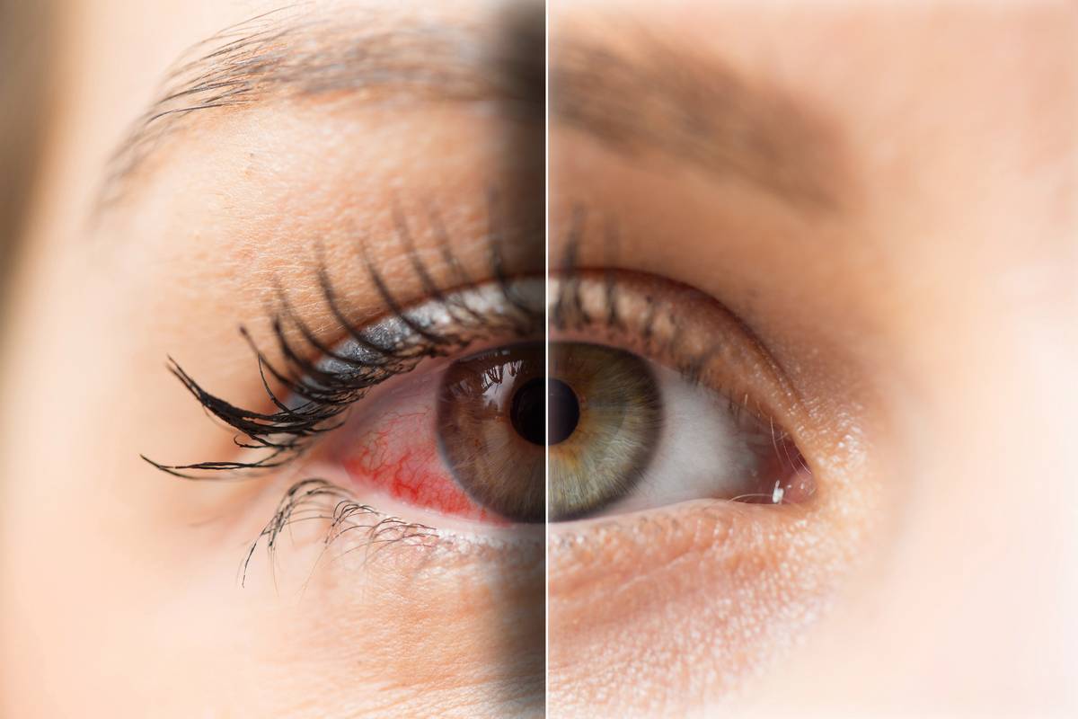 Close-up of female dry eye before and after, split image