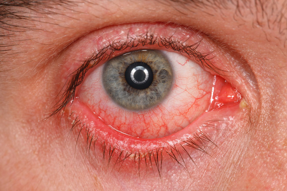 Close-up of irritated red eye with pus