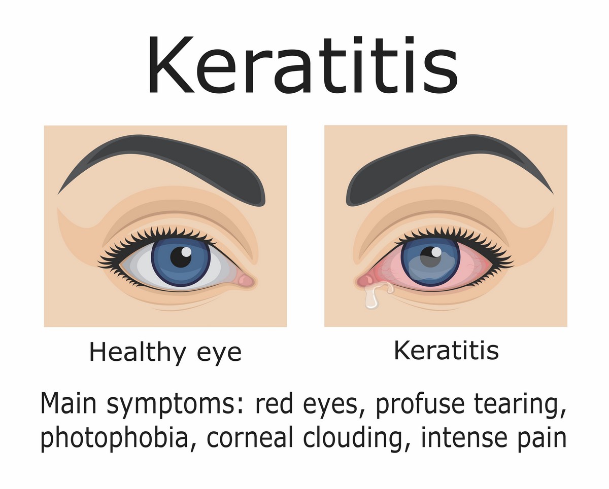 Common Contact Problems and How You Can Them LensPure